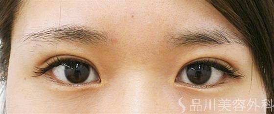 症例NO.25301のAFTER写真