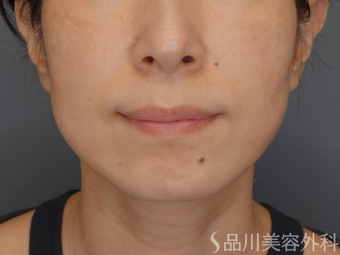 症例NO.72182のBEFORE写真