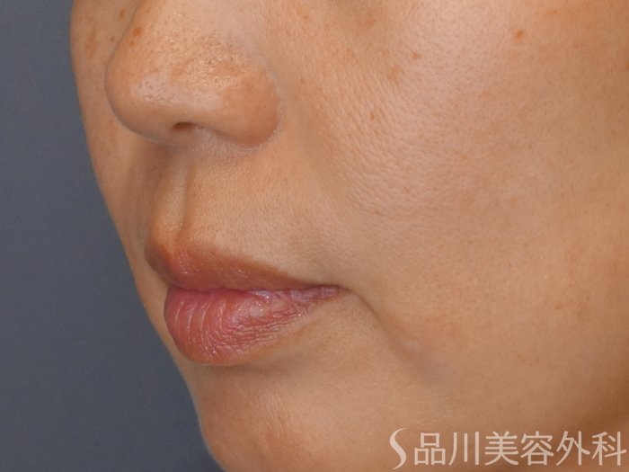 症例NO.71828のAFTER写真