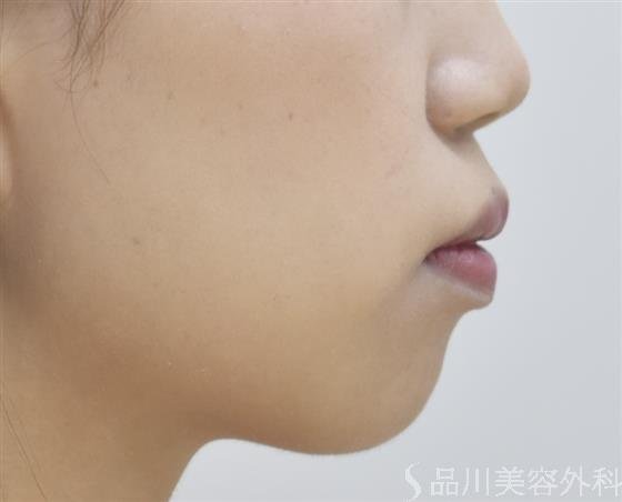 症例NO.45652のBEFORE写真