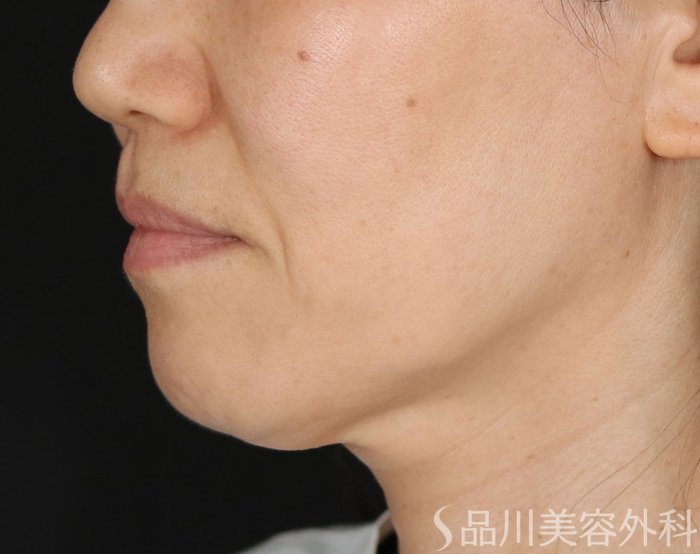 症例NO.73973のBEFORE写真