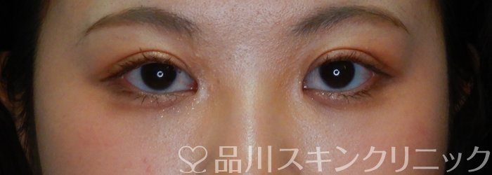 症例NO.62414のAFTER写真