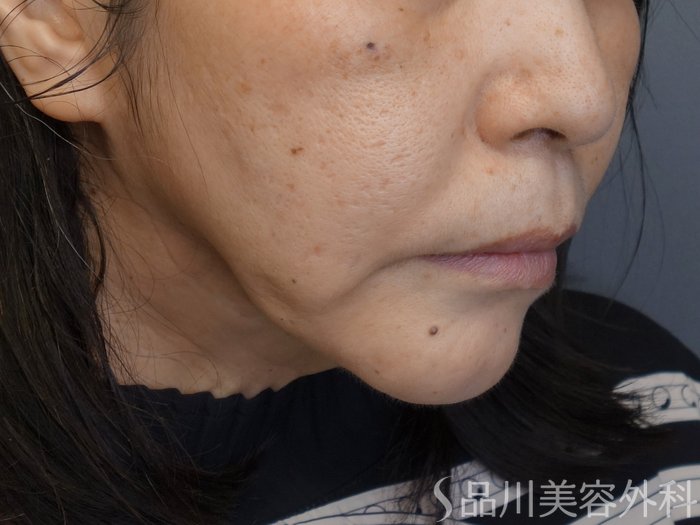 症例NO.69761のBEFORE写真