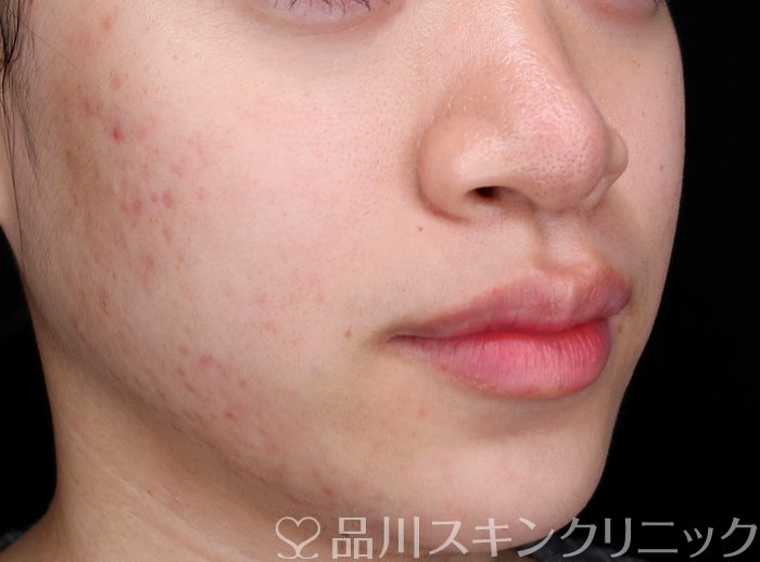 症例NO.62757のAFTER写真