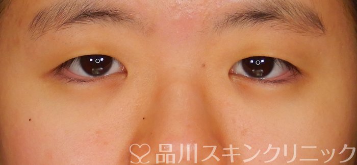 症例NO.66451のBEFORE写真
