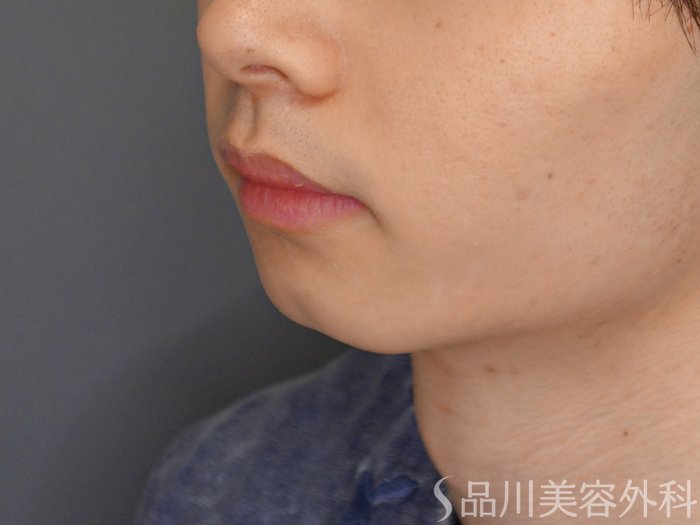 症例NO.65330のBEFORE写真
