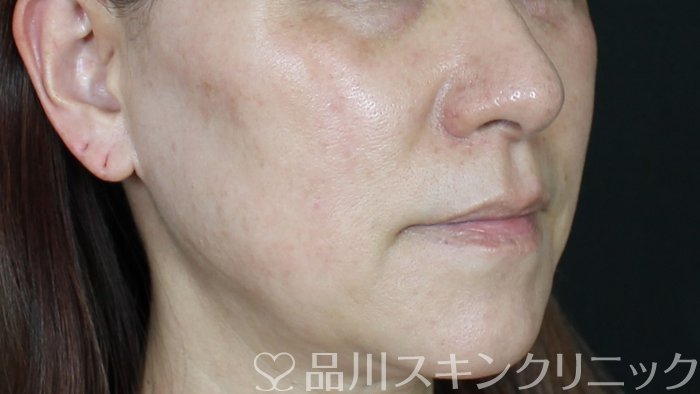 症例NO.71199のBEFORE写真