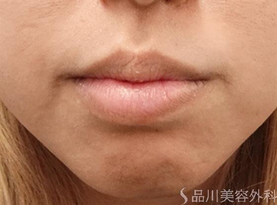 症例NO.34705のBEFORE写真