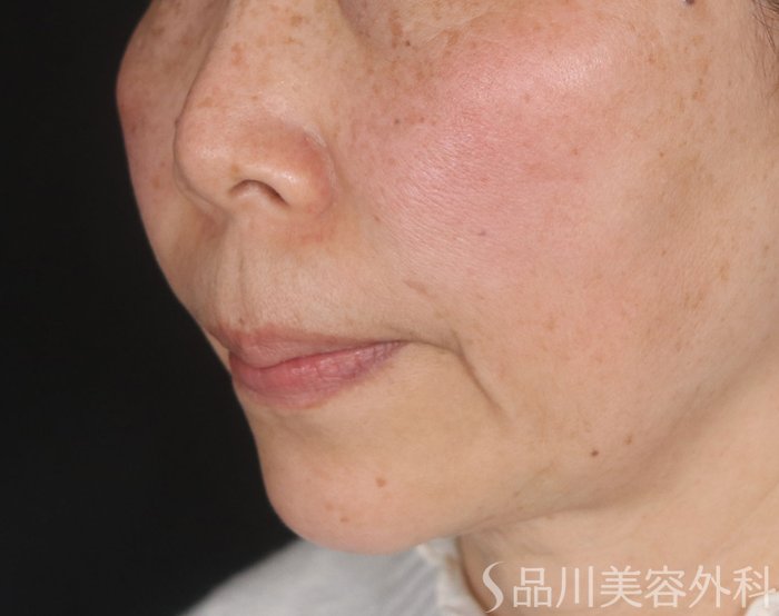 症例NO.72915のBEFORE写真