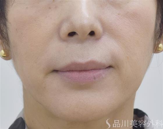 症例NO.45358のBEFORE写真