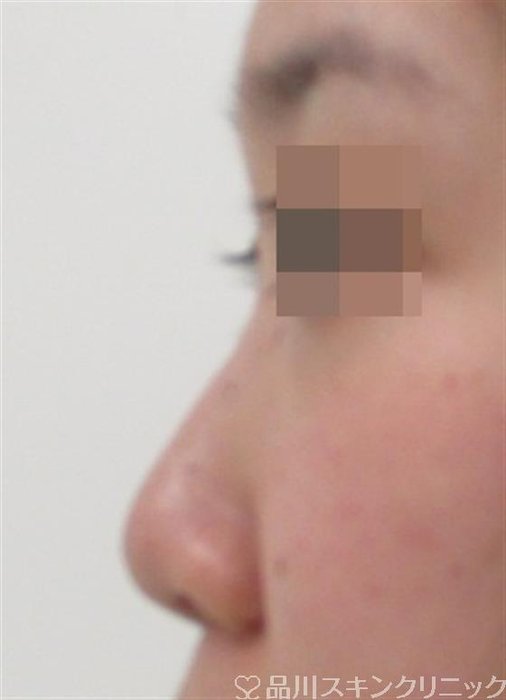 症例NO.29161のBEFORE写真