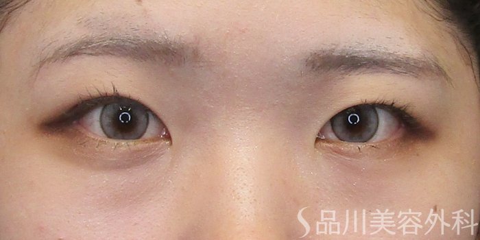 症例NO.75033のAFTER写真