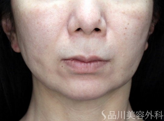 症例NO.70640のAFTER写真