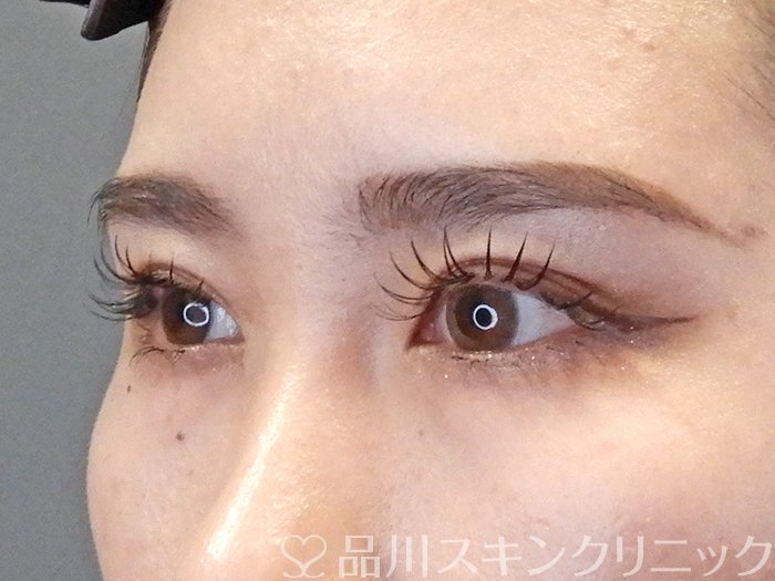 症例NO.65349のBEFORE写真