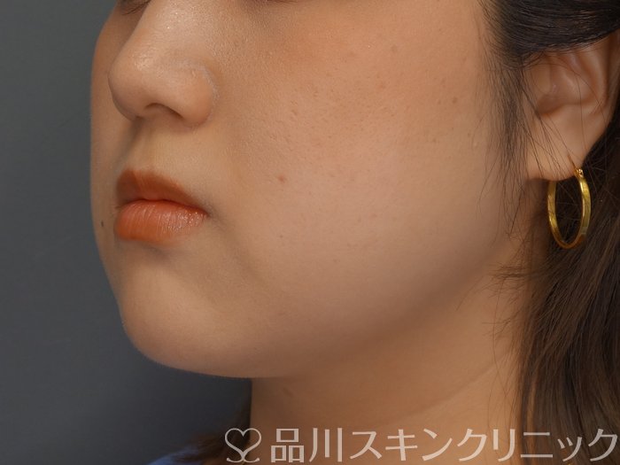 症例NO.74129のAFTER写真