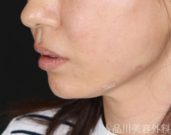 症例NO.72358のAFTER写真