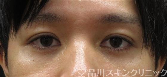 症例NO.61366のAFTER写真