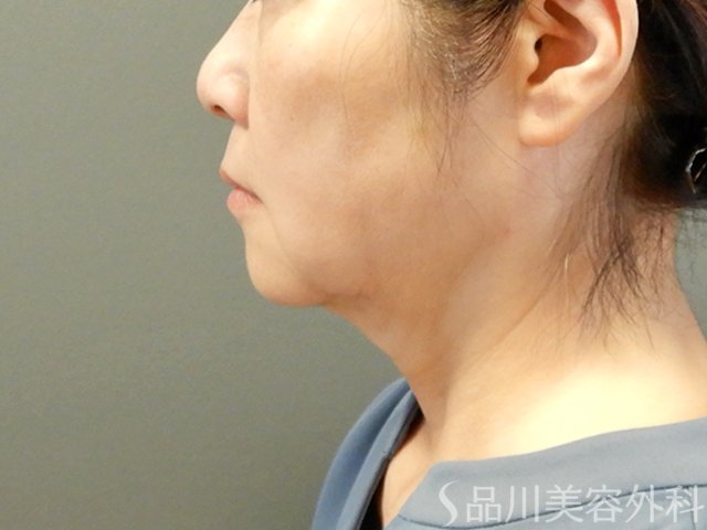 症例NO.67754のAFTER写真