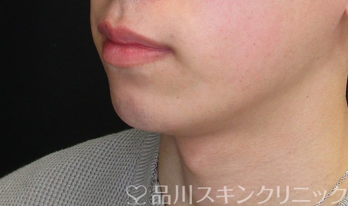 症例NO.73447のBEFORE写真