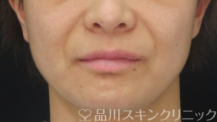 症例NO.72762のBEFORE写真