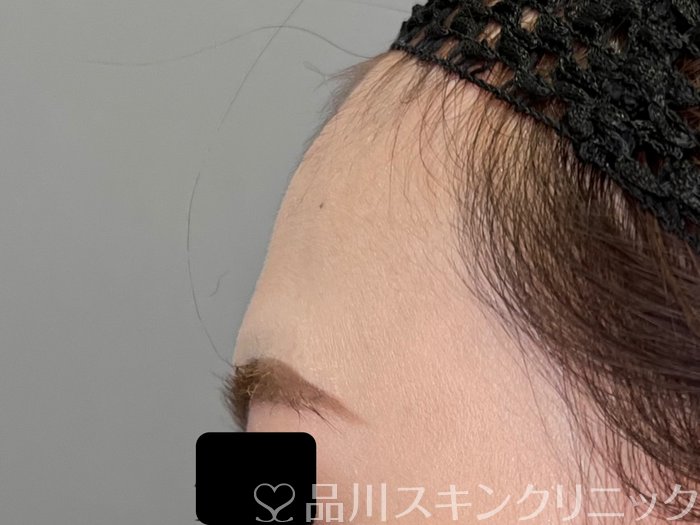 症例NO.70075のBEFORE写真