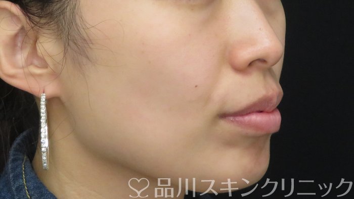 症例NO.71378のBEFORE写真