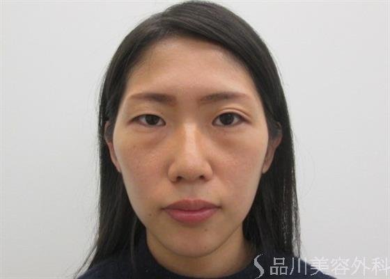 症例NO.26472のBEFORE写真