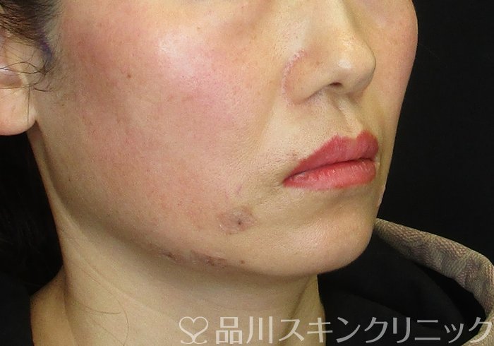 症例NO.75206のAFTER写真