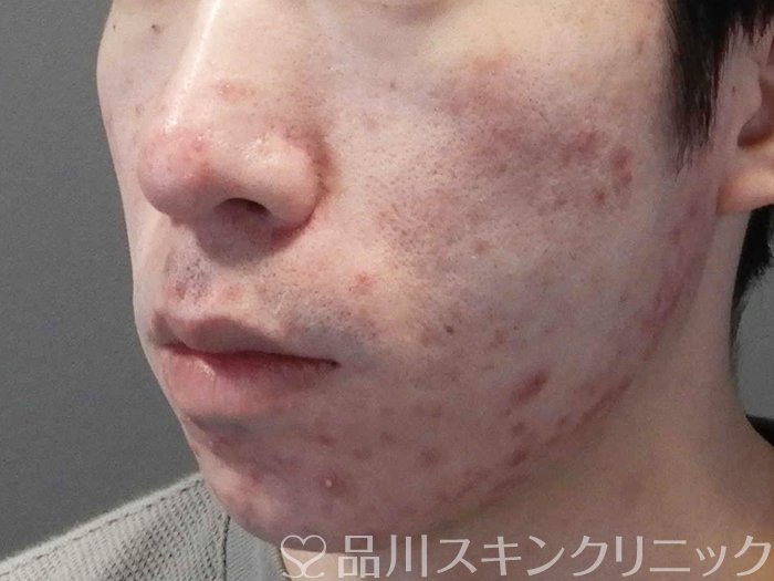 症例NO.69377のBEFORE写真