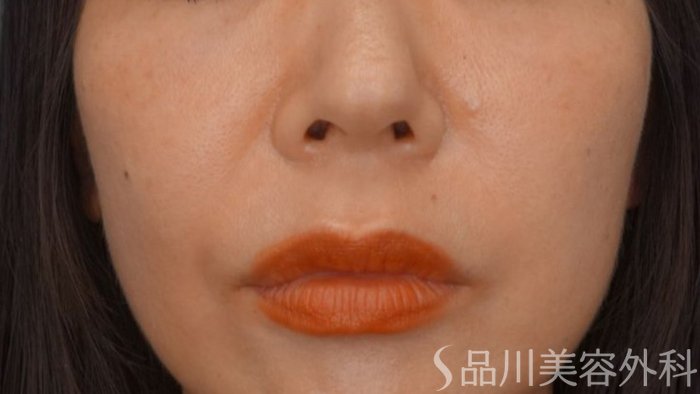 症例NO.65070のBEFORE写真