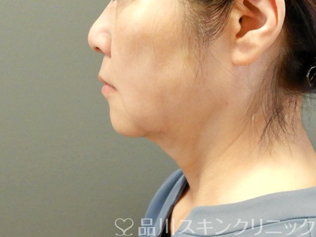 症例NO.67754のAFTER写真