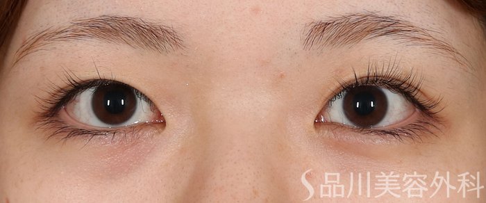 症例NO.71013のBEFORE写真