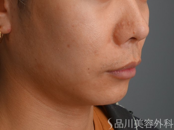 症例NO.73755のBEFORE写真