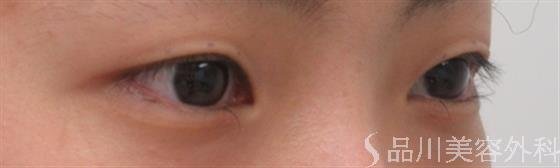 症例NO.35498のBEFORE写真