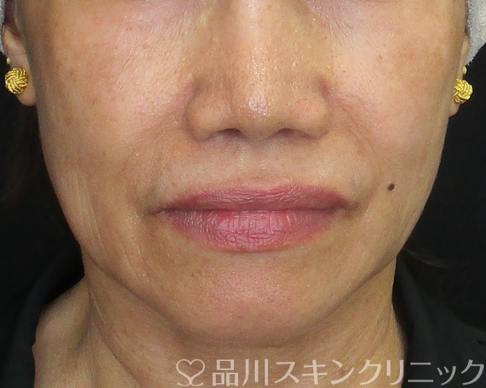 症例NO.74947のBEFORE写真