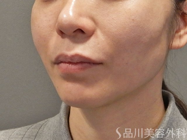 症例NO.73592のAFTER写真