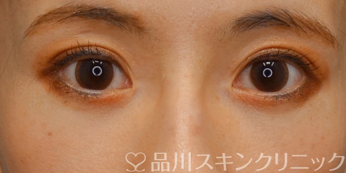 症例NO.74054のAFTER写真