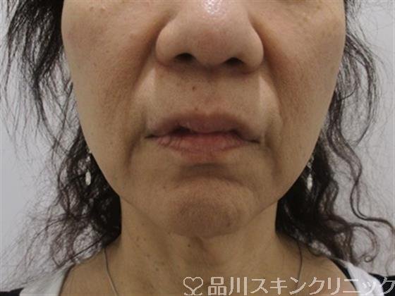 症例NO.38338のBEFORE写真