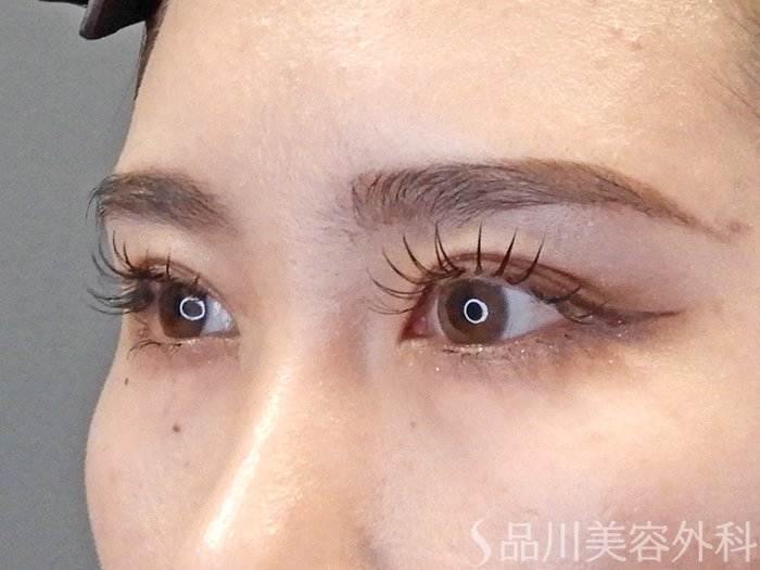 症例NO.65349のBEFORE写真