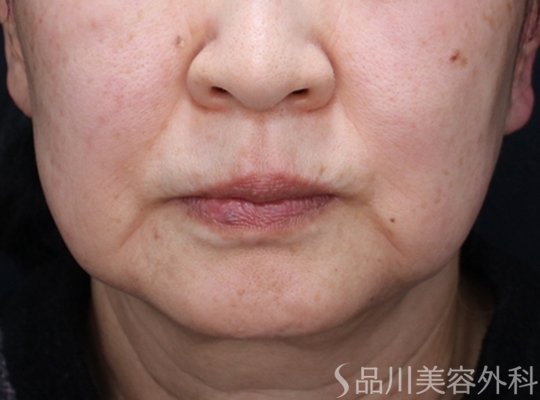 症例NO.73764のBEFORE写真