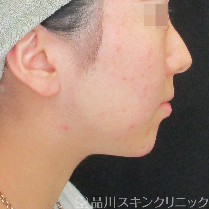 症例NO.74179のAFTER写真