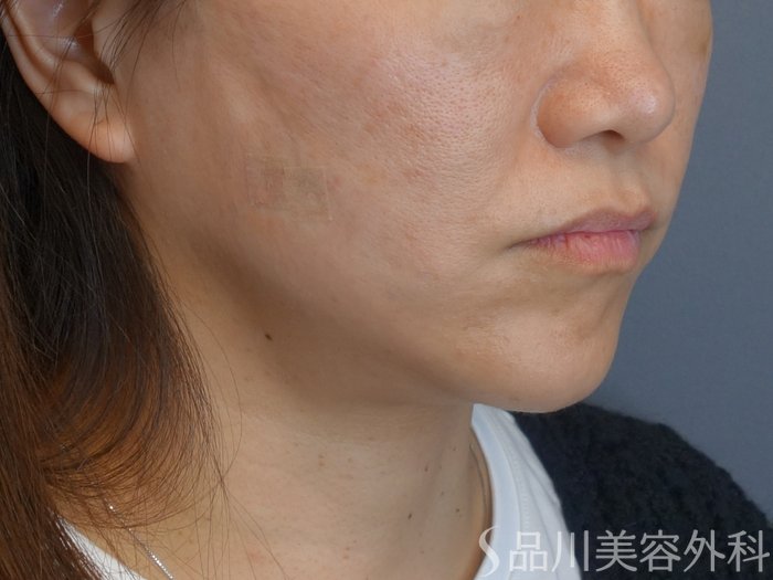 症例NO.72619のAFTER写真