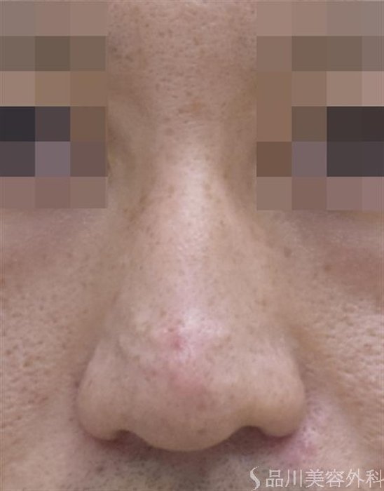 症例NO.48136のBEFORE写真