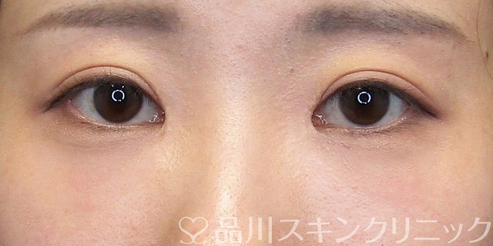症例NO.75157のAFTER写真