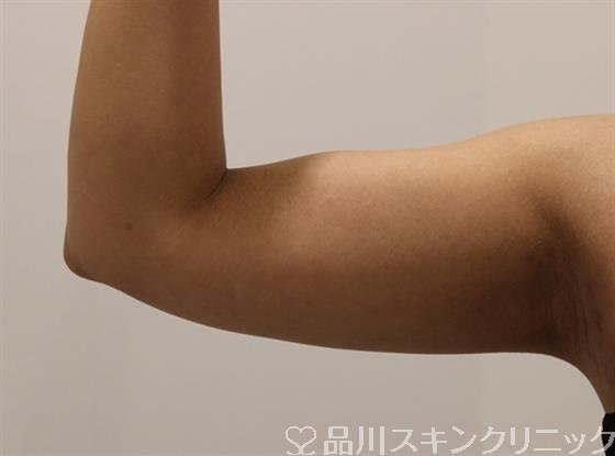 症例NO.48971のAFTER写真
