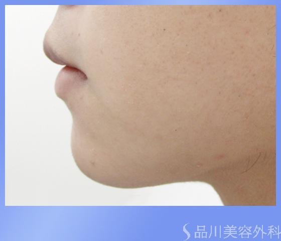 症例NO.1147のAFTER写真