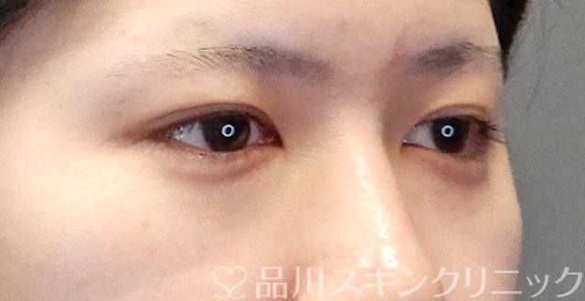 症例NO.67384のBEFORE写真