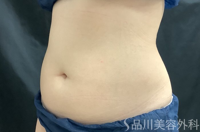 症例NO.68158のBEFORE写真