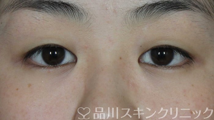 症例NO.72311のBEFORE写真