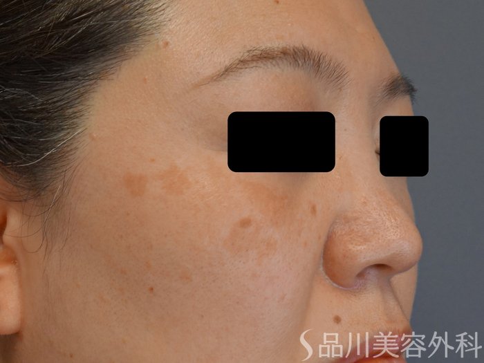症例NO.74040のBEFORE写真